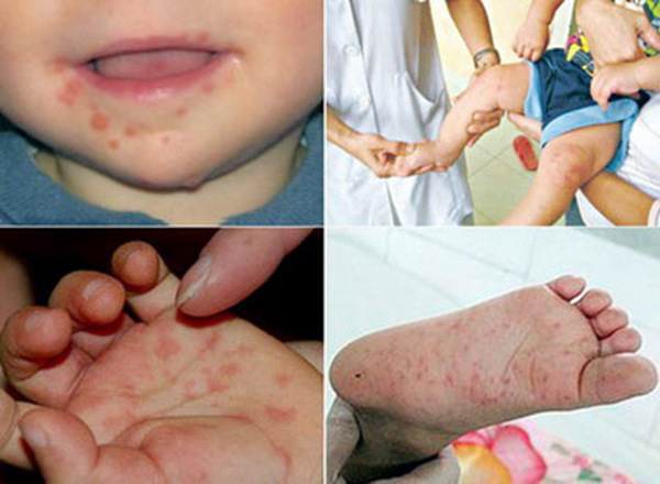 Ban Thường vụ Tỉnh ủy chỉ thị tăng cường phòng, chống bệnh tay – chân – miệng